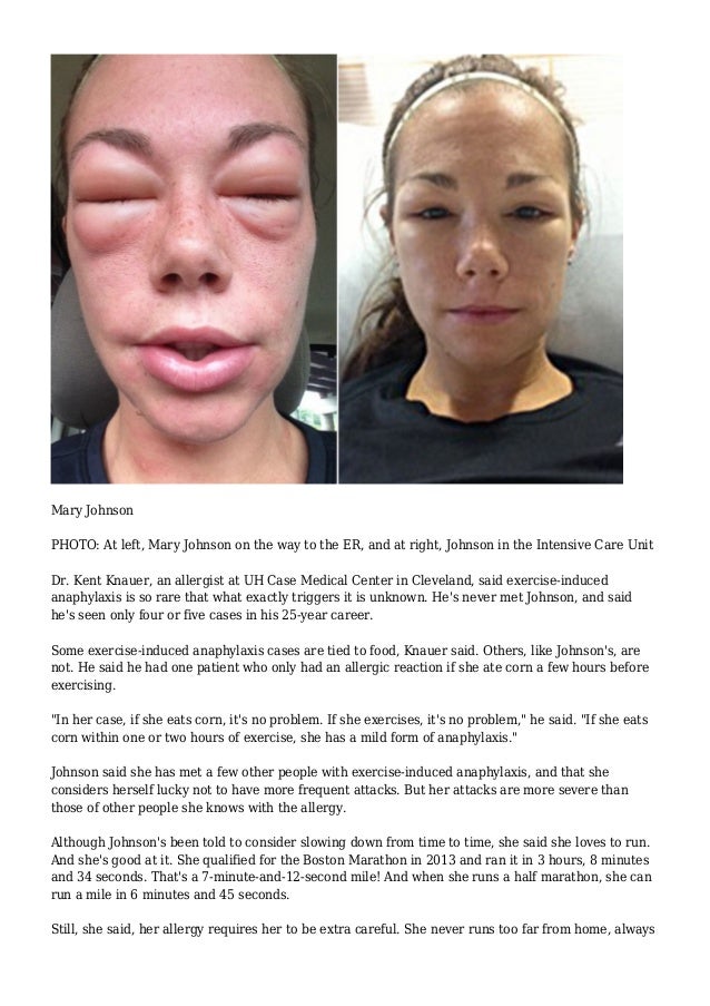 exercise induced allergies all the best exercise in 2018 marathon runner wont let allergy to exercise hold her back 2 638?cb=1430662793 exercise induced allergies all the best exercise in 2018